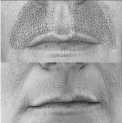 Tratamiento Tensor con Fibroblast / (Plasma Lift)