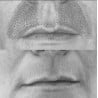 Tratamiento Tensor con Fibroblast / (Plasma Lift)