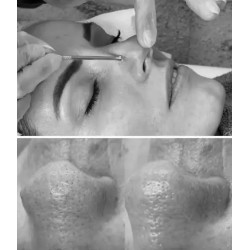 Tratamiento Piel Seborraica / Acne Skin Treatment