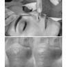 Tratamiento Piel Seborraica / Acne Skin Treatment