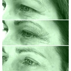 Tratamiento Tensor con Fibroblast / (Plasma Lift)