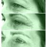 Tratamiento Tensor con Fibroblast / (Plasma Lift)