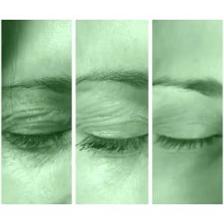 Tratamiento Tensor con Fibroblast / (Plasma Lift)