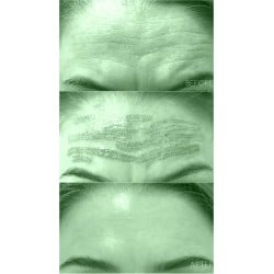 Tratamiento Tensor con Fibroblast / (Plasma Lift)