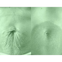 Tratamiento Tensor con Fibroblast / (Plasma Lift)