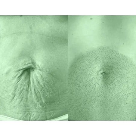 Tratamiento Tensor con Fibroblast / (Plasma Lift)