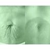 Tratamiento Tensor con Fibroblast / (Plasma Lift)