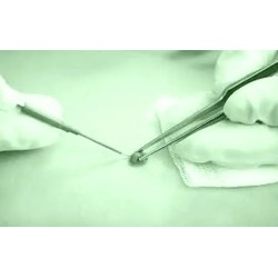 Exceresis de Verrugas / Plasma Skin Lesion Removal