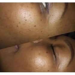 Exceresis de Verrugas / Plasma Skin Lesion Removal