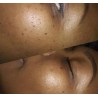 Exceresis de Verrugas / Plasma Skin Lesion Removal