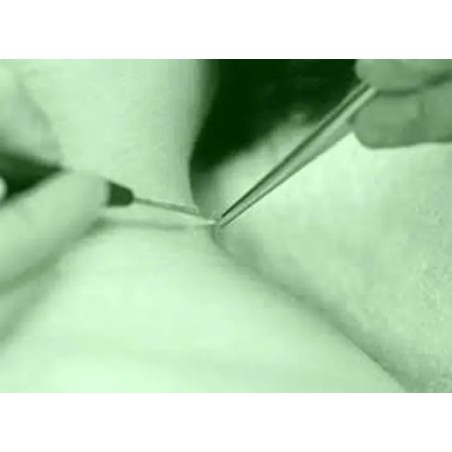 Exceresis de Verrugas / Plasma Skin Lesion Removal