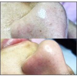 Limpieza Profunda / Deep Pore Cleansing Facial