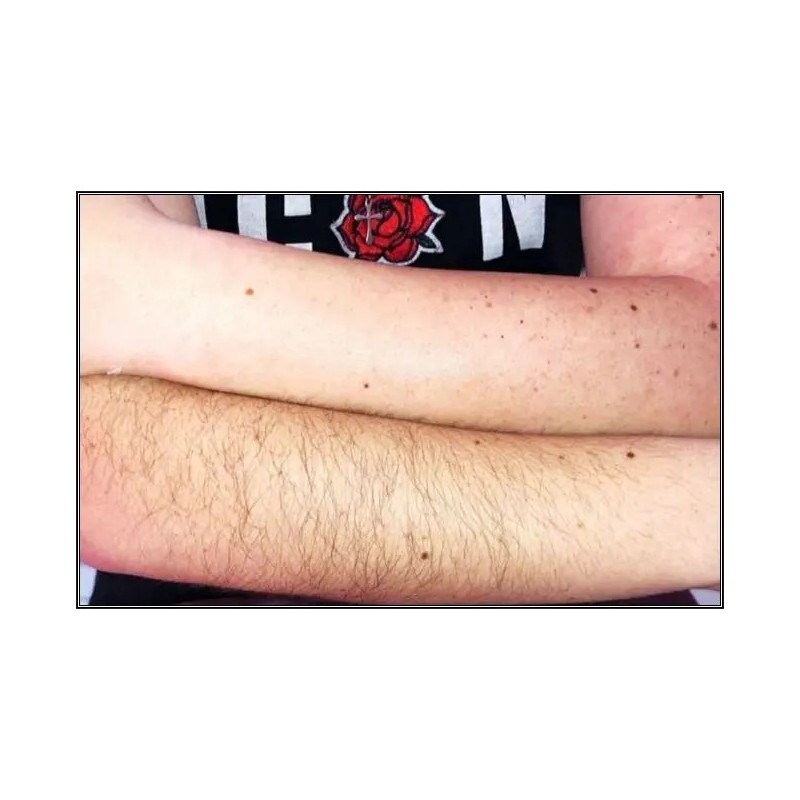 Depilación de Brazo / Arm Hair Removal