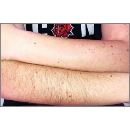 Depilación de Brazo / Arm Hair Removal