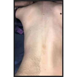 Depilación de Espalada / Back Hair Removal