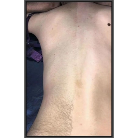 Depilación de Espalada / Back Hair Removal