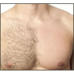 Depilación de Pecho / Chest Hair Removal