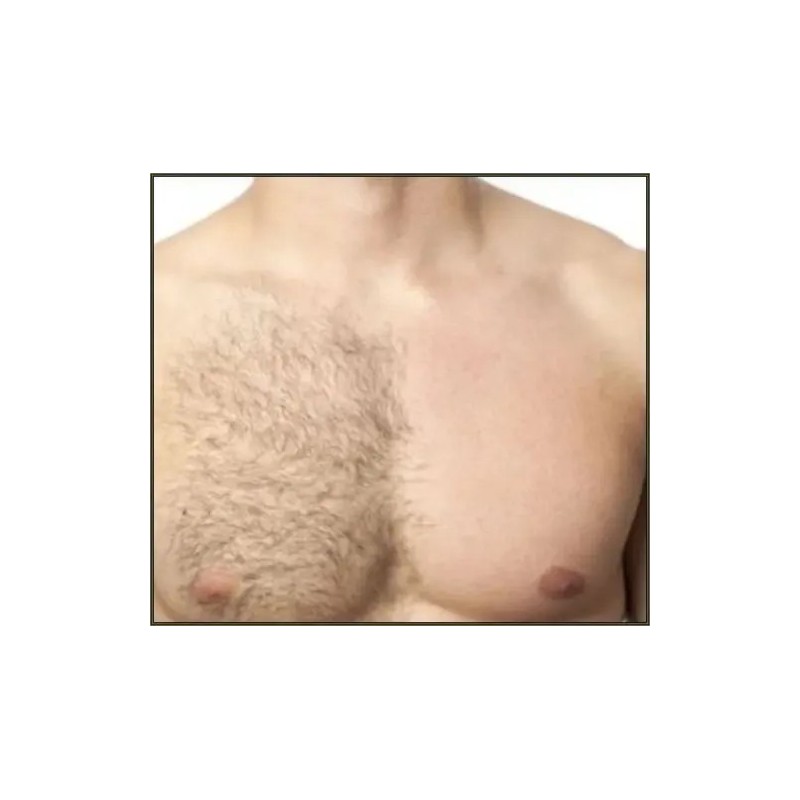Depilación de Pecho / Chest Hair Removal