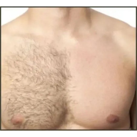 Depilación de Pecho / Chest Hair Removal